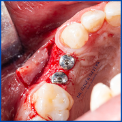 İnce kemik varlığında biorejenerasyon destekli kemik tozu uygulamamız ile yeni kemik oluşumu