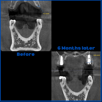 İnce kemik varlığında biorejenerasyon destekli kemik tozu uygulamamız ile yeni kemik oluşumu
