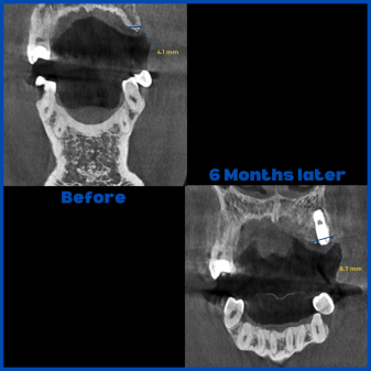 İnce kemik varlığında biorejenerasyon destekli kemik tozu uygulamamız ile yeni kemik oluşumu