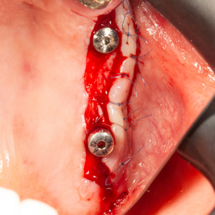 İmplant etrafındaki kemik açıklığını kemik grefti ile tedavi ettiğimiz vakamız