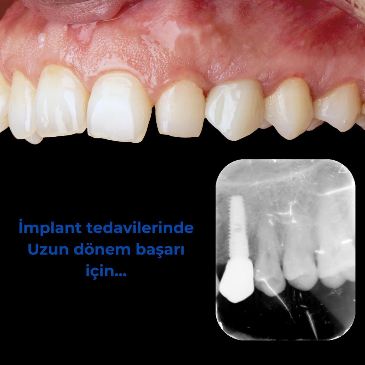 Başarılı bir implant tedavisi için kriterler nelerdir?