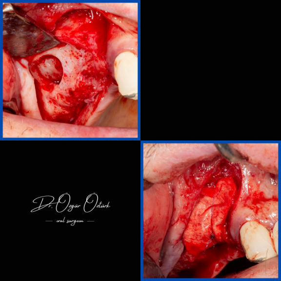 İmplant etrafındaki kemik açıklığını kemik grefti ile tedavi ettiğimiz vakamız