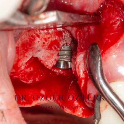 İmplant etrafındaki kemik açıklığını kemik grefti ile tedavi ettiğimiz vakamız
