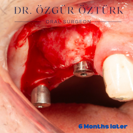 İmplant etrafındaki kemik açıklığını kemik grefti ile tedavi ettiğimiz vakamız