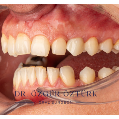 Başarılı bir implant tedavisi için kriterler nelerdir?