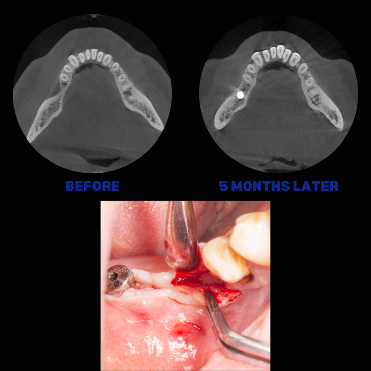 İmplant etrafındaki kemik açıklığını kemik grefti ile tedavi ettiğimiz vakamızdan biri