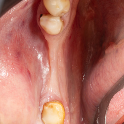İmplant etrafındaki kemik açıklığını kemik grefti ile tedavi ettiğimiz vakamızdan biri