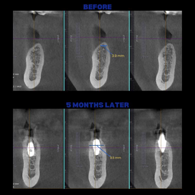 İmplant etrafındaki kemik açıklığını kemik grefti ile tedavi ettiğimiz vakamızdan biri