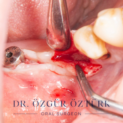 İmplant etrafındaki kemik açıklığını kemik grefti ile tedavi ettiğimiz vakamızdan biri