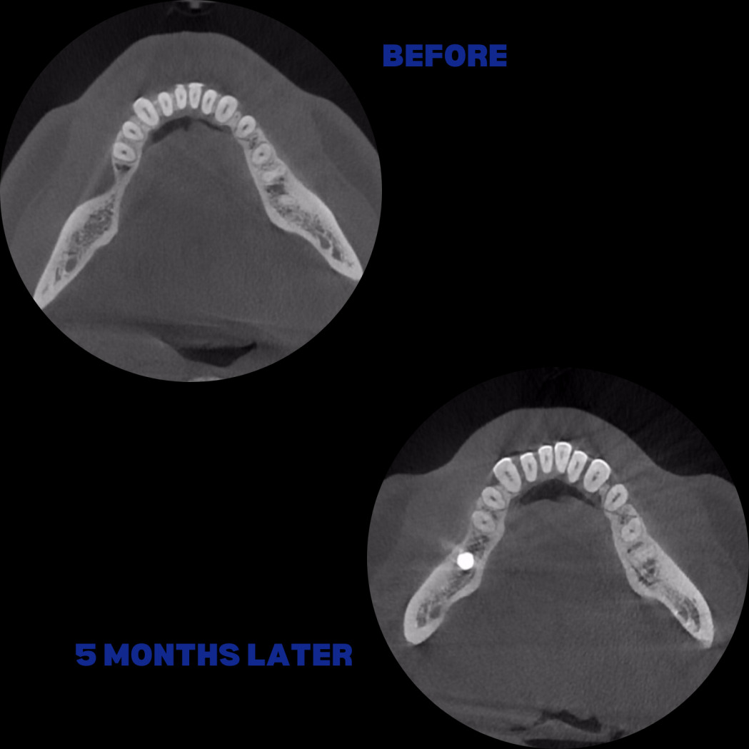 İmplant etrafındaki kemik açıklığını kemik grefti ile tedavi ettiğimiz vakamızdan biri
