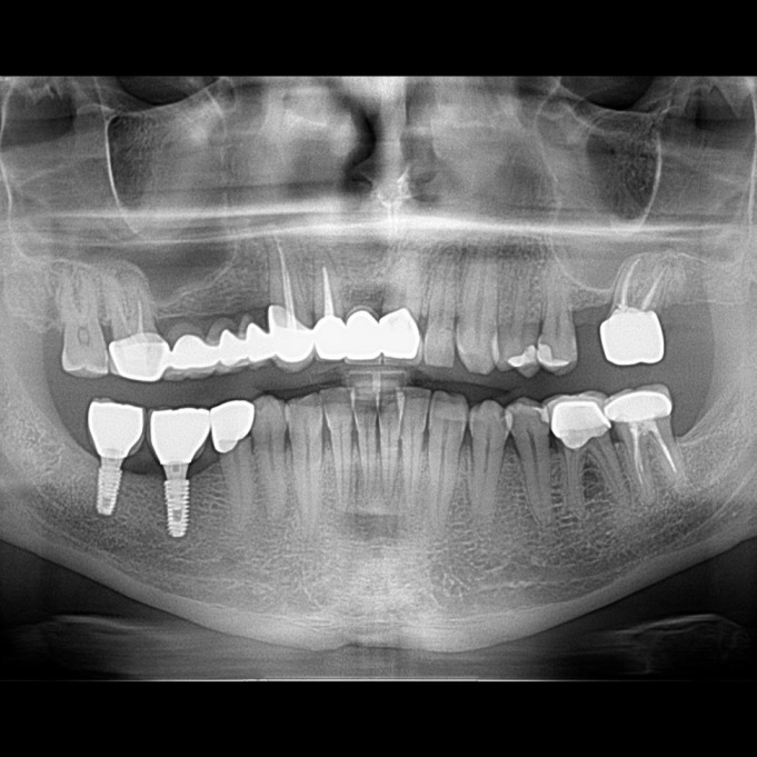 İmplant etrafındaki kemik açıklığını kemik grefti ile tedavi ettiğimiz vakamızdan biri