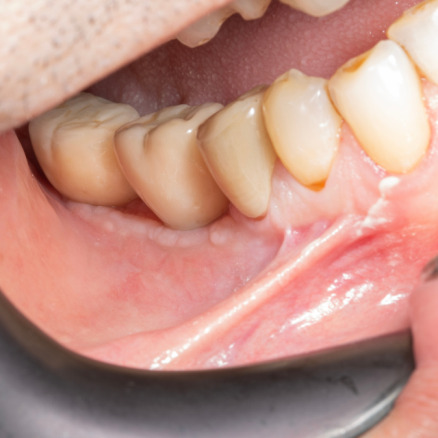 İmplant etrafındaki kemik açıklığını kemik grefti ile tedavi ettiğimiz vakamızdan biri