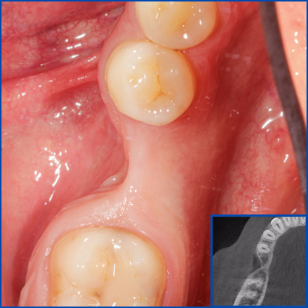 Kist nedeni ile çene kemiğinde defekt oluşmuş vakamıza sert ve yumuşak doku ogmentasyonu uyguladık