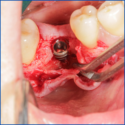 Kist nedeni ile çene kemiğinde defekt oluşmuş vakamıza sert ve yumuşak doku ogmentasyonu uyguladık