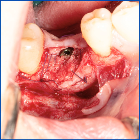 Kist nedeni ile çene kemiğinde defekt oluşmuş vakamıza sert ve yumuşak doku ogmentasyonu uyguladık