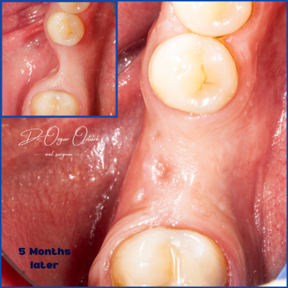 Kist nedeni ile çene kemiğinde defekt oluşmuş vakamıza sert ve yumuşak doku ogmentasyonu uyguladık