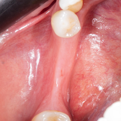 Diş çekiminin yıllar önce yapılmış olmasına bağlı olarak ince kemik varlığında implant ve kemik grefti uygulandı