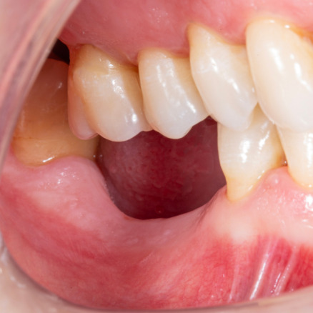 Diş çekiminin yıllar önce yapılmış olmasına bağlı olarak ince kemik varlığında implant ve kemik grefti uygulandı