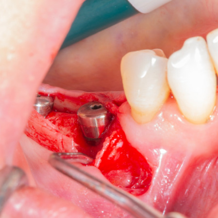 Diş çekiminin yıllar önce yapılmış olmasına bağlı olarak ince kemik varlığında implant ve kemik grefti uygulandı