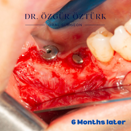 Diş çekiminin yıllar önce yapılmış olmasına bağlı olarak ince kemik varlığında implant ve kemik grefti uygulandı