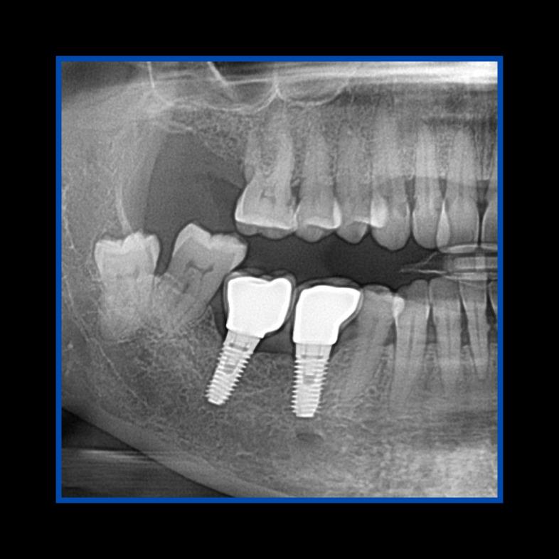 Diş çekiminin yıllar önce yapılmış olmasına bağlı olarak ince kemik varlığında implant ve kemik grefti uygulandı