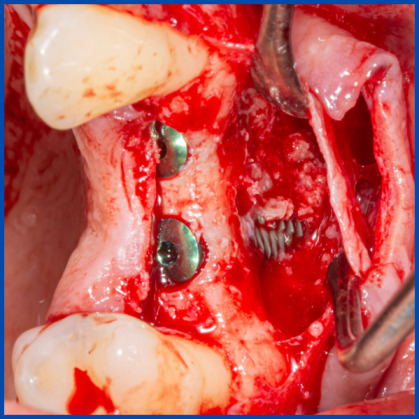 İnce kemik varlığında biorejenerasyon destekli kemik tozu uygulamamız ile yeni kemik oluşumu