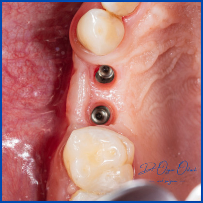 İnce kemik varlığında biorejenerasyon destekli kemik tozu uygulamamız ile yeni kemik oluşumu
