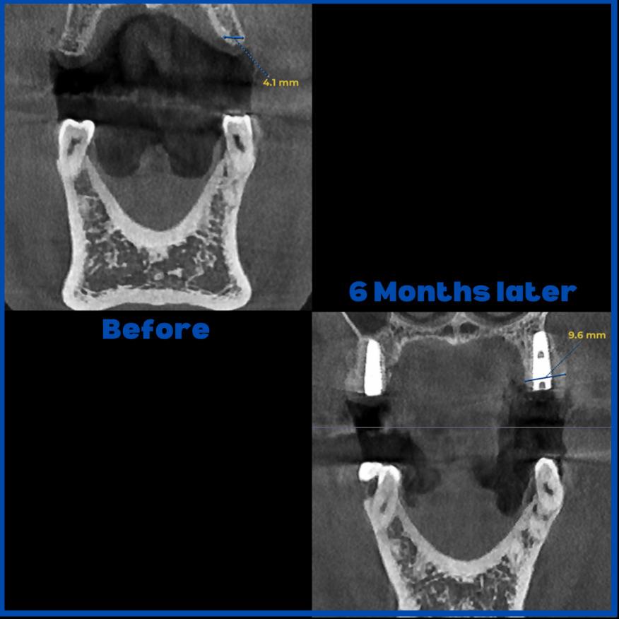 İnce kemik varlığında biorejenerasyon destekli kemik tozu uygulamamız ile yeni kemik oluşumu