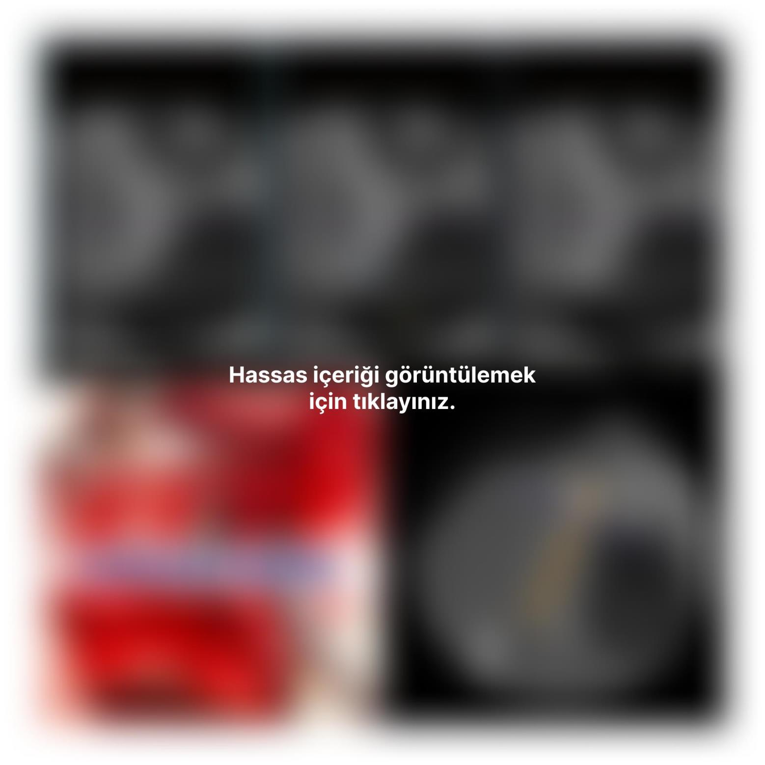 İmplant etrafındaki kemik açıklığını kemik grefti ile tedavi ettiğimiz vakamız