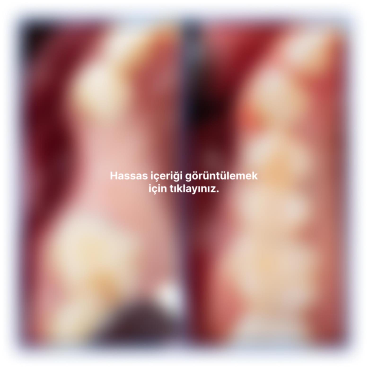 İnce kemik varlığında biorejenerasyon destekli kemik tozu uygulamamız ile yeni kemik oluşumu