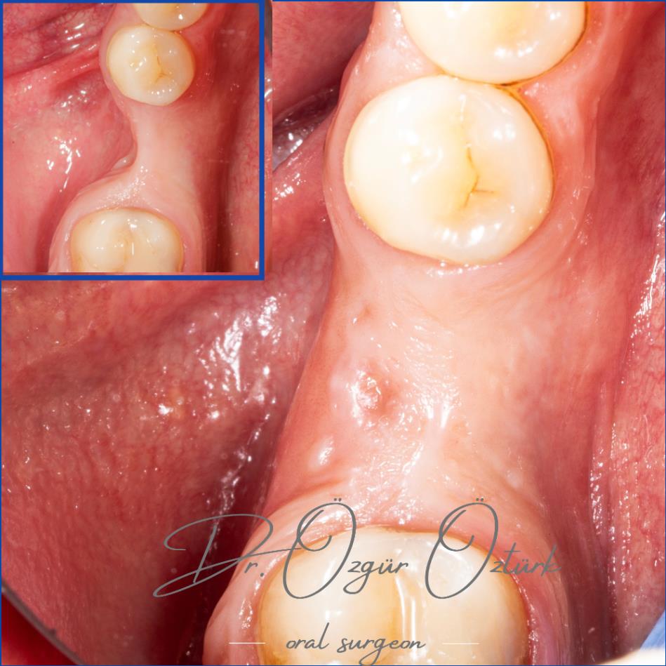 Yumuşak Doku (Dişeti) Ogmentasyonları 