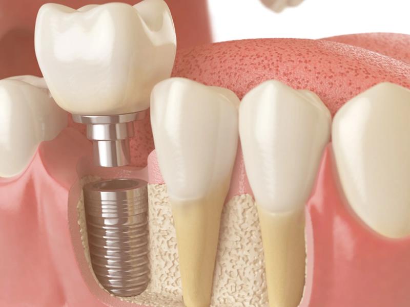 İmplant Öncesi Kemik Grefti