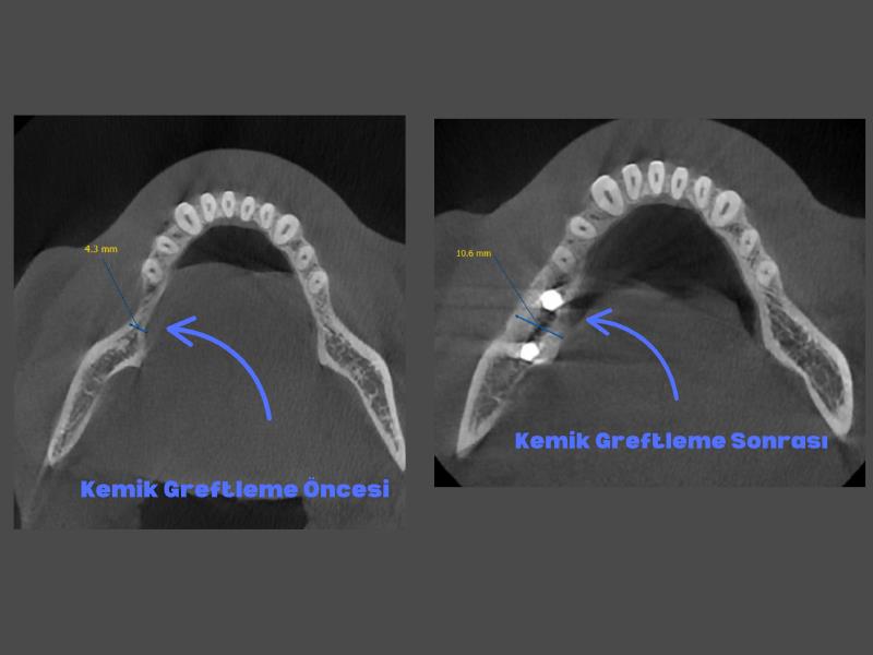 Kemik Grefti / Tozu Uygulamaları